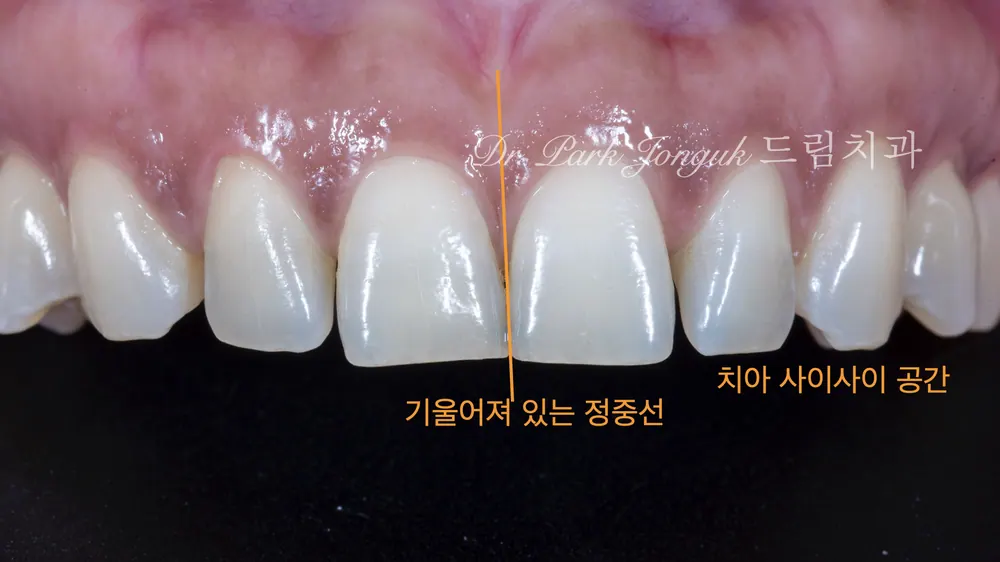 블랙 트라이앵글의 라미네이트 치료 본문 사진 2