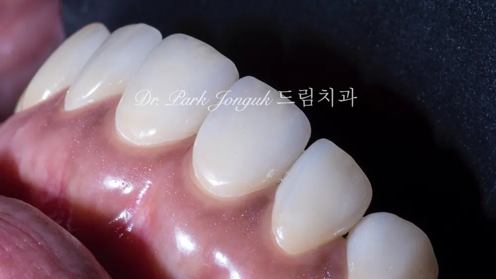 블랙 트라이앵글의 라미네이트 치료 본문 사진 9