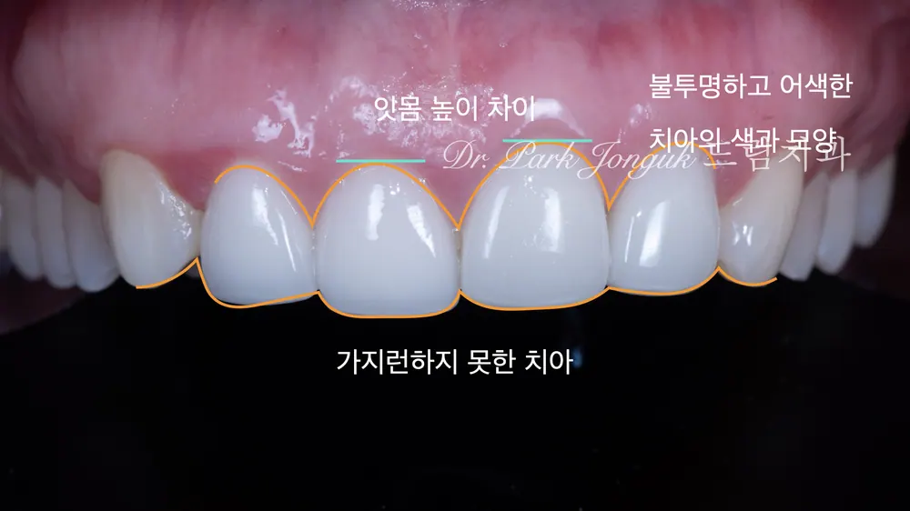 잇몸라인이 비대칭인 라미네이트, 올세라믹 크라운의 재시술 본문 사진 2