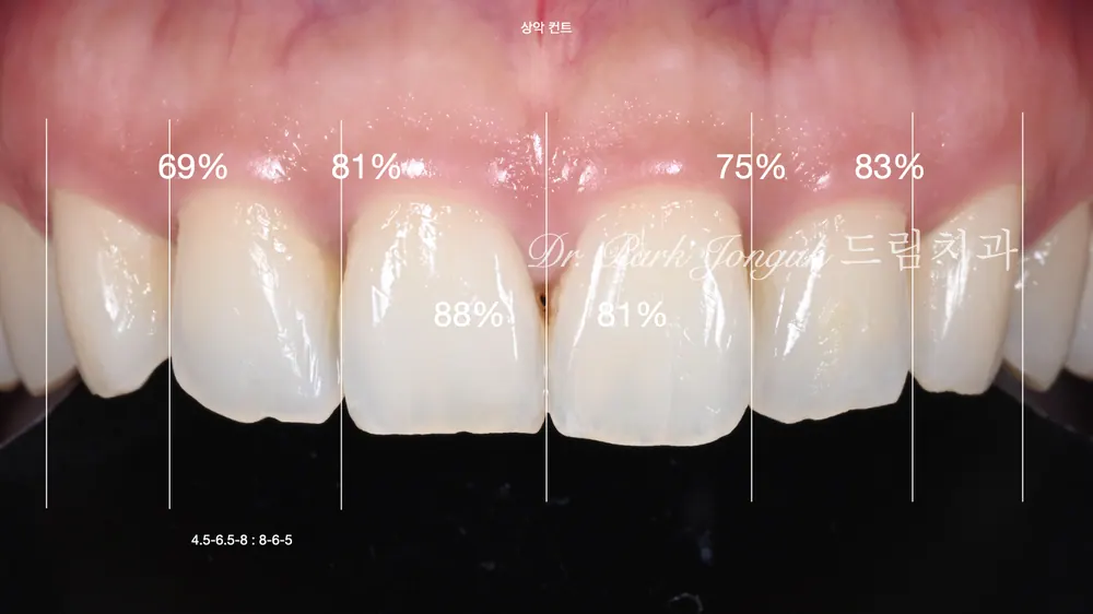 無切削ラミネートベニアは、すべての方に可能なのでしょうか — 写真7