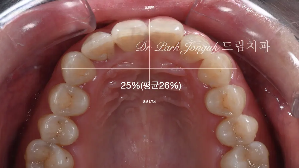 無切削ラミネートベニアは、すべての方に可能なのでしょうか — 写真8