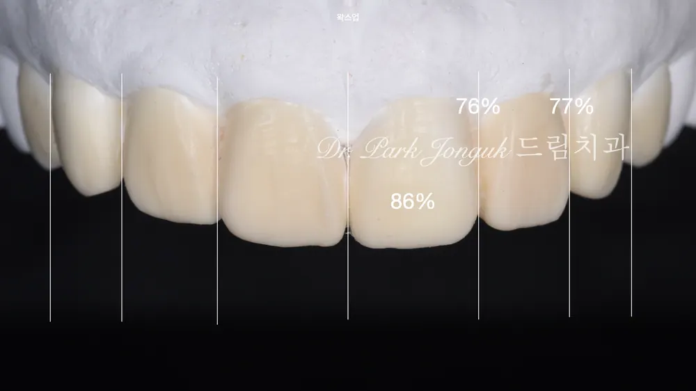 無切削ラミネートベニアは、すべての方に可能なのでしょうか — 写真13