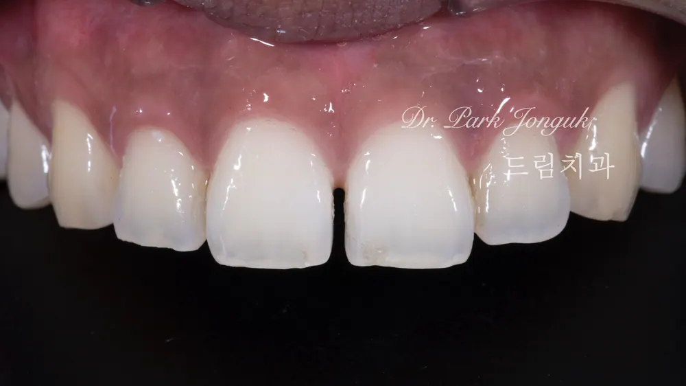 Veneer bán phần không mài răng cho trường hợp thưa răng — ảnh 1