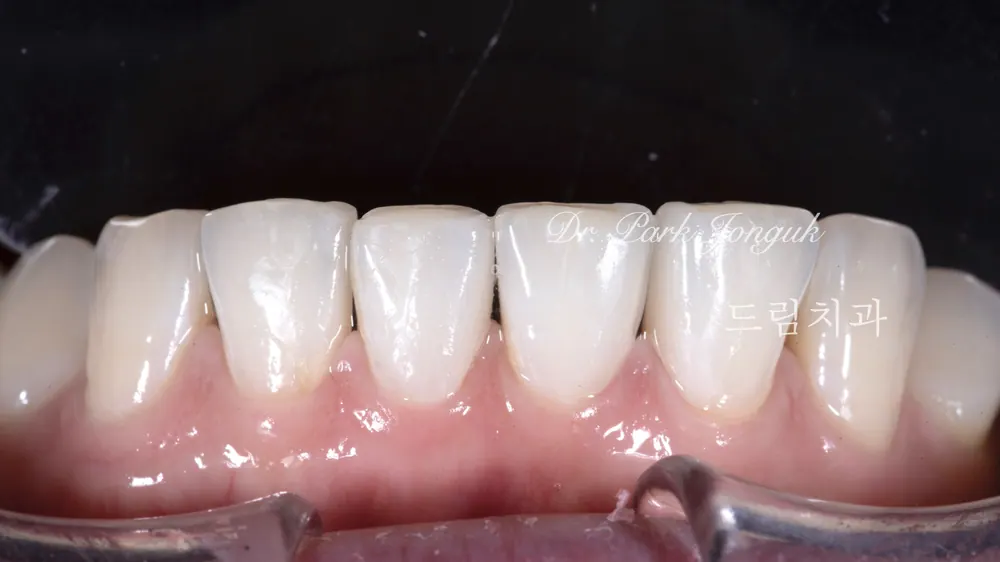 Veneer bán phần không mài răng cho trường hợp thưa răng — ảnh 8