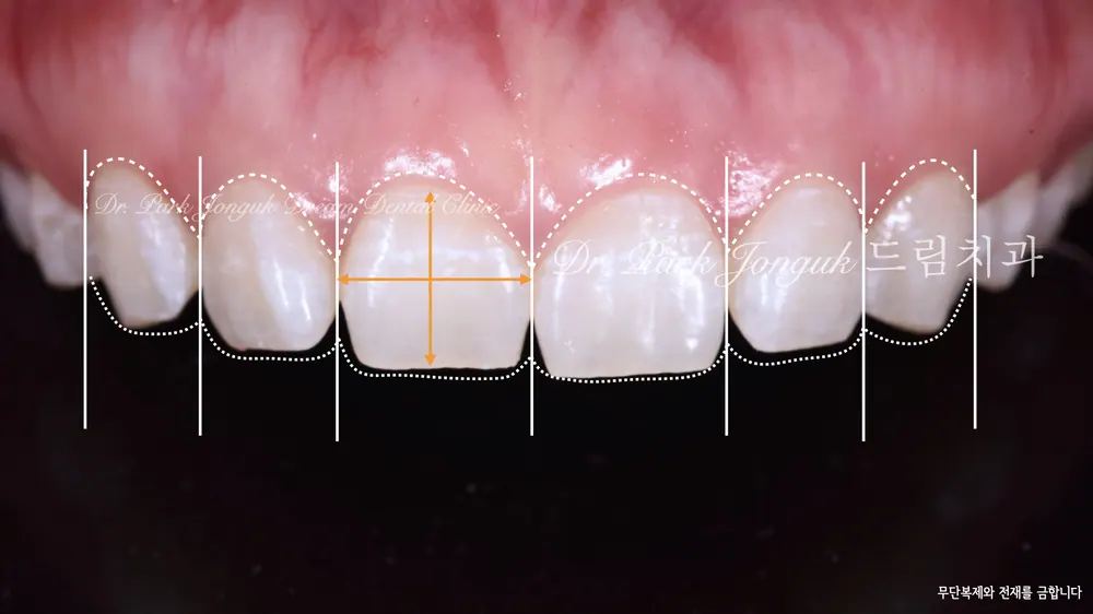 Dán sứ Veneer không mài răng, mài răng tối thiểu giúp giảm thiểu tối đa tác dụng phụ — ảnh 2