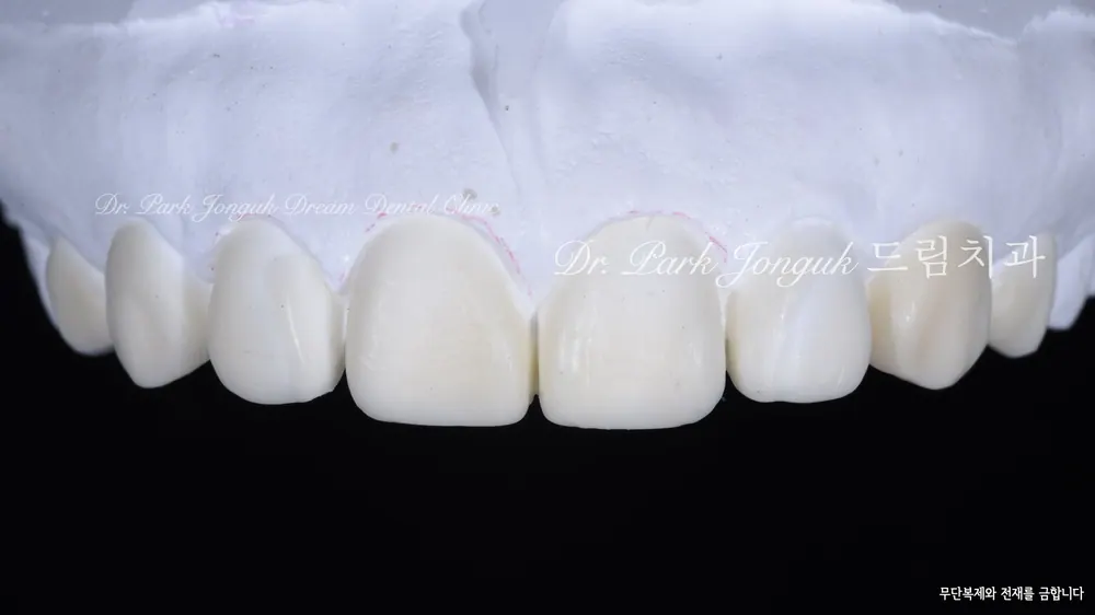 Dán sứ Veneer không mài răng, mài răng tối thiểu giúp giảm thiểu tối đa tác dụng phụ — ảnh 4