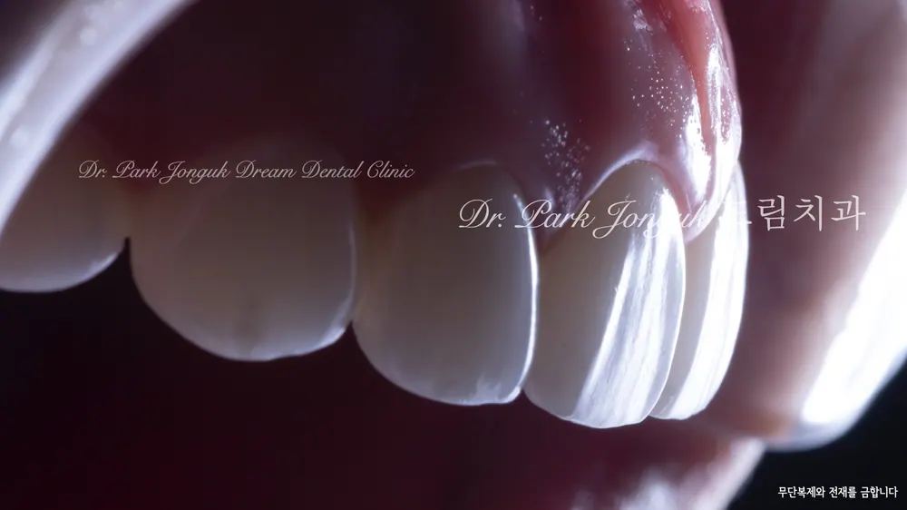 Dán sứ Veneer không mài răng, mài răng tối thiểu giúp giảm thiểu tối đa tác dụng phụ — ảnh 18