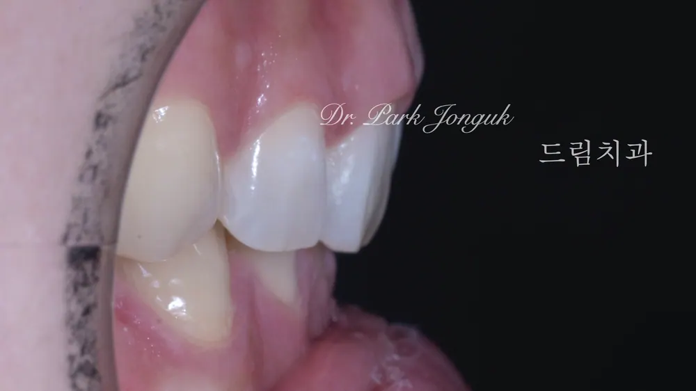 Veneer sứ không mài răng chỉ thực hiện được khi đủ điều kiện — ảnh 2