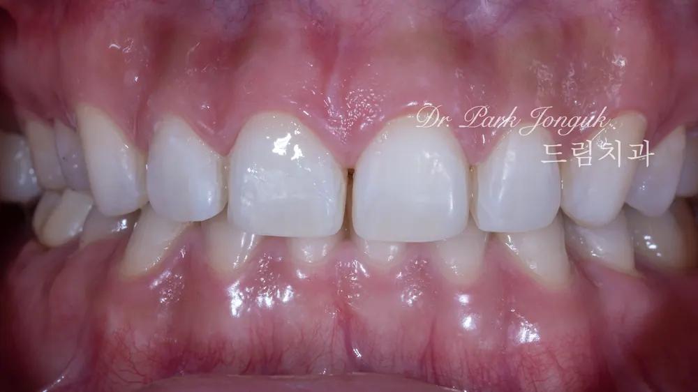 Veneer sứ không mài răng chỉ thực hiện được khi đủ điều kiện — ảnh 5