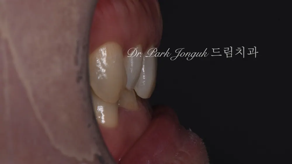 무삭제 라미네이트 모두가 되는 것은 아닙니다 본문 사진 2