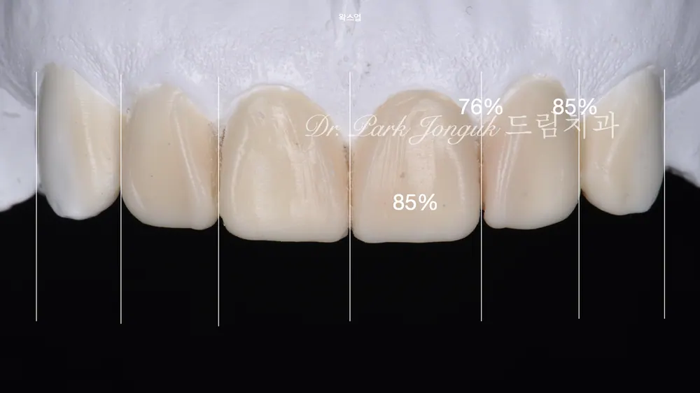 무삭제 라미네이트 모두가 되는 것은 아닙니다 본문 사진 6