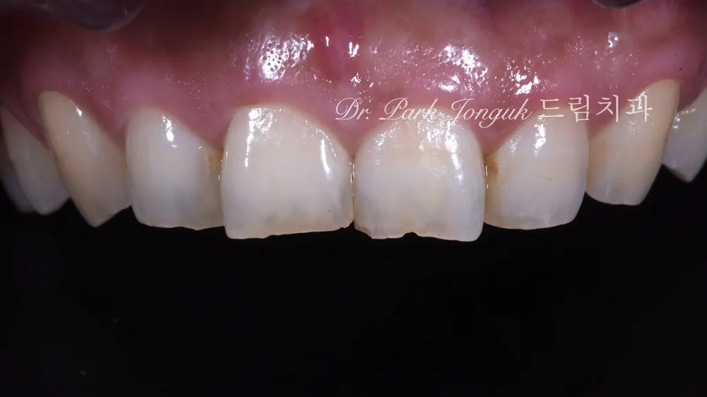 Dán sứ Veneer răng cửa của Nha khoa Dream Gangnam theo đuổi vẻ đẹp tự nhiên — ảnh 5