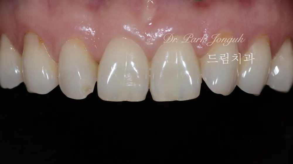 Veneer mài răng tối thiểu — giảm mài răng đến mức tối đa — ảnh 1