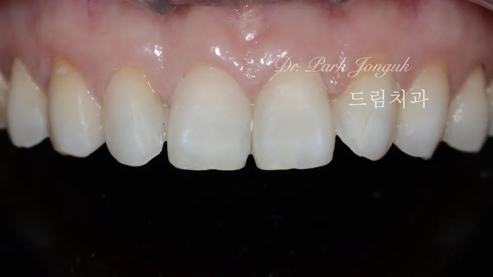 Veneer mài răng tối thiểu — giảm mài răng đến mức tối đa — ảnh 2