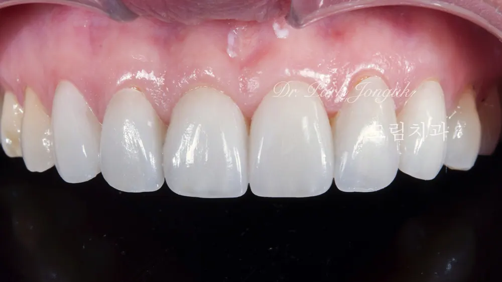 Veneer mài răng tối thiểu — giảm mài răng đến mức tối đa — ảnh 3