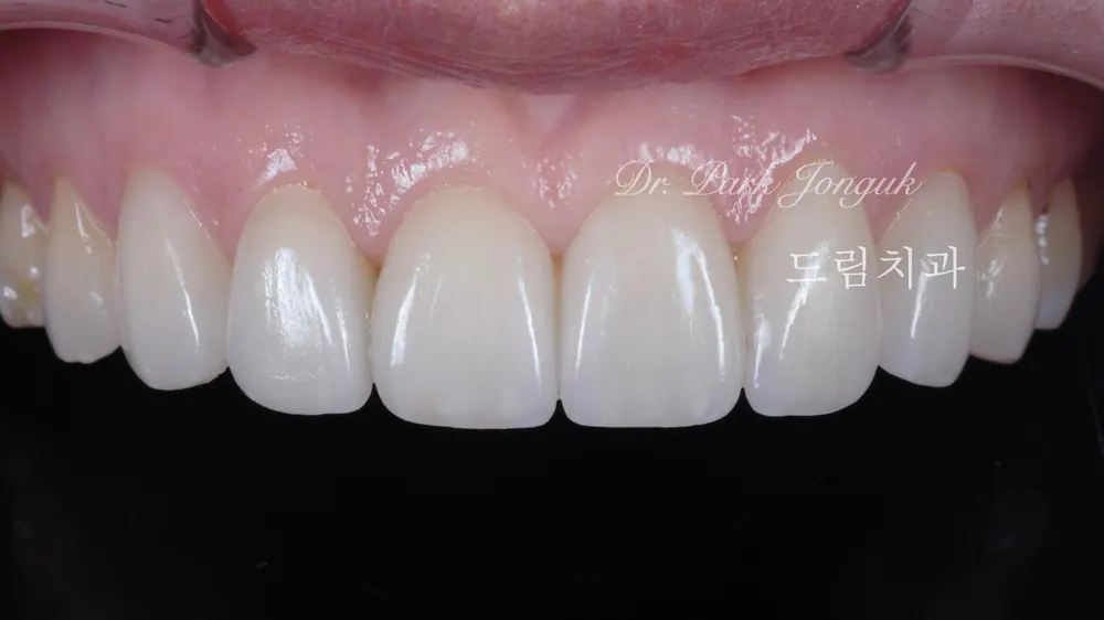 Veneer mài răng tối thiểu — giảm mài răng đến mức tối đa — ảnh 4