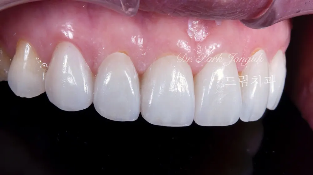 Veneer mài răng tối thiểu — giảm mài răng đến mức tối đa — ảnh 5