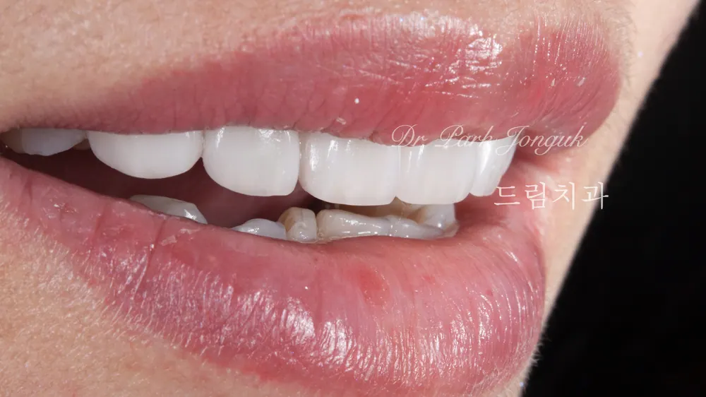 Veneer mài răng tối thiểu — giảm mài răng đến mức tối đa — ảnh 7