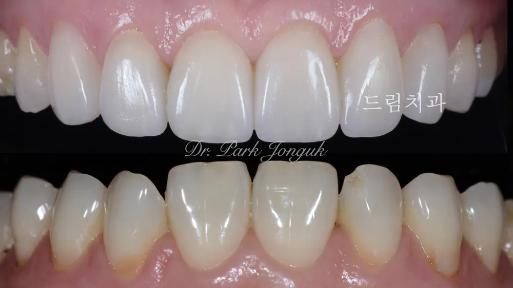 Veneer mài răng tối thiểu — giảm mài răng đến mức tối đa — ảnh 8