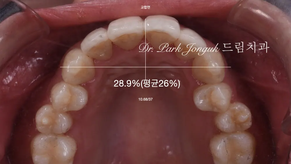 将当日完成方式导致生硬的瓷贴面自然地进行再治疗 — 图6