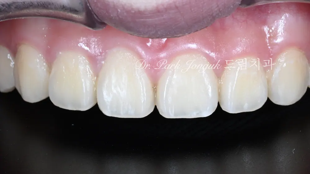 No-Prep Veneers: How to Minimize Tooth Reduction — photo 1