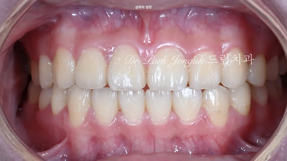 No-Prep Veneers: How to Minimize Tooth Reduction — photo 2