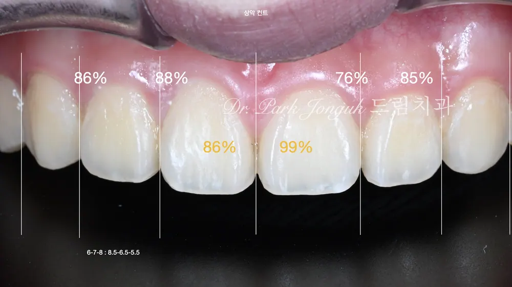 No-Prep Veneers: How to Minimize Tooth Reduction — photo 4
