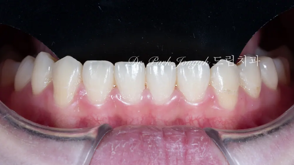 No-Prep Veneers: How to Minimize Tooth Reduction — photo 5