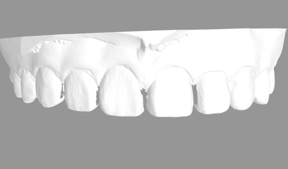 No-Prep Veneers: How to Minimize Tooth Reduction — photo 6