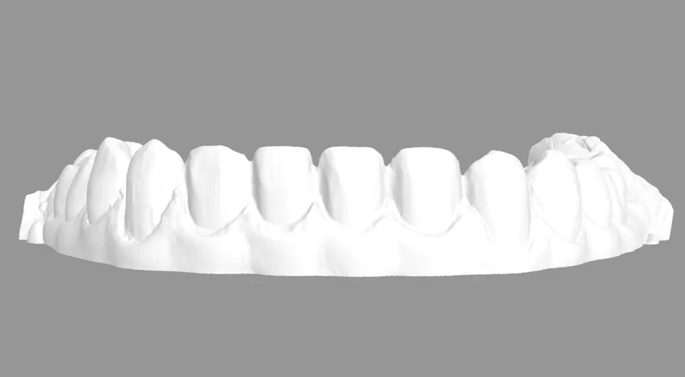 No-Prep Veneers: How to Minimize Tooth Reduction — photo 7