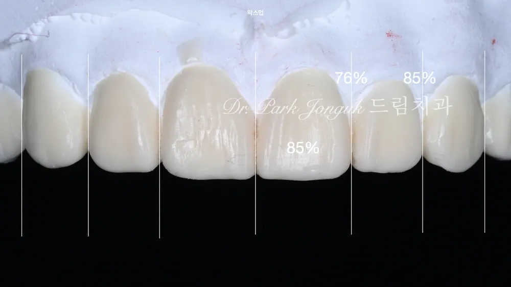 No-Prep Veneers: How to Minimize Tooth Reduction — photo 8