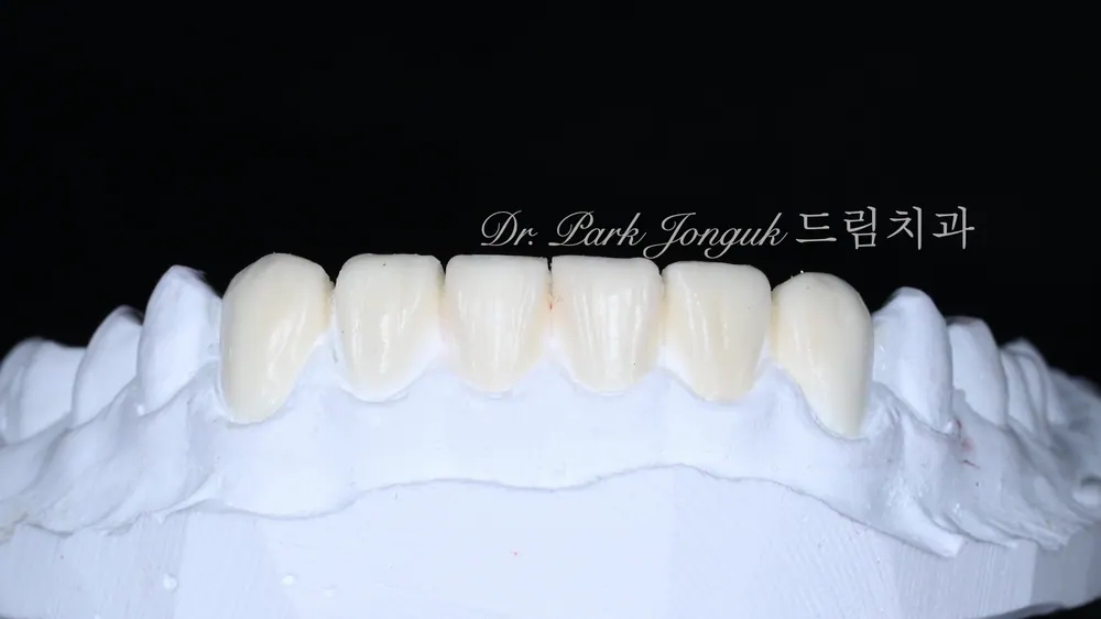 No-Prep Veneers: How to Minimize Tooth Reduction — photo 9