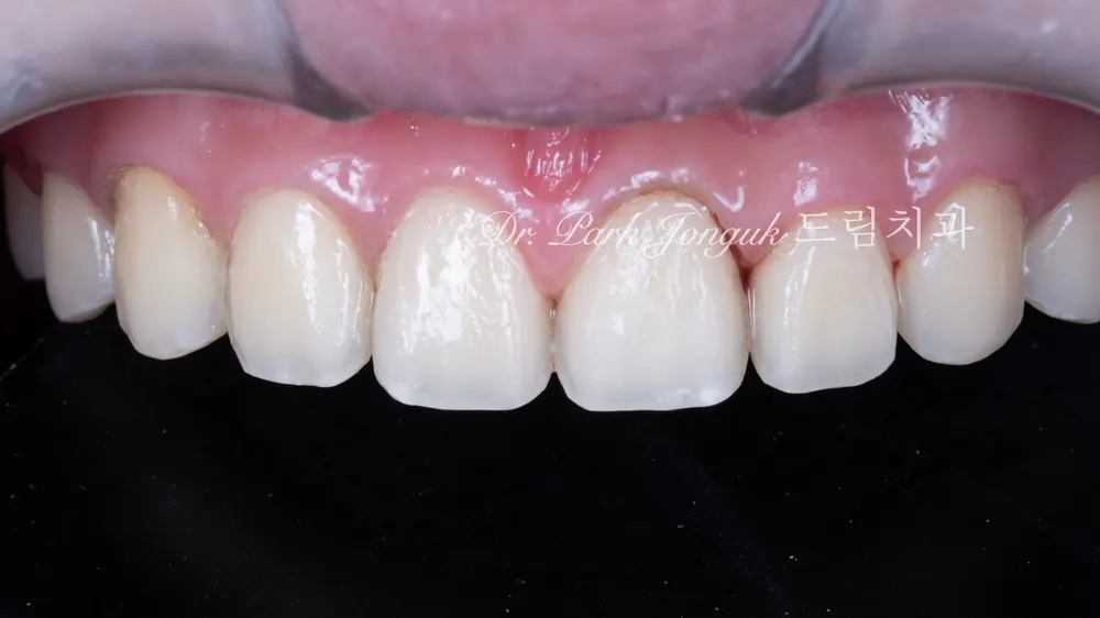 No-Prep Veneers: How to Minimize Tooth Reduction — photo 10