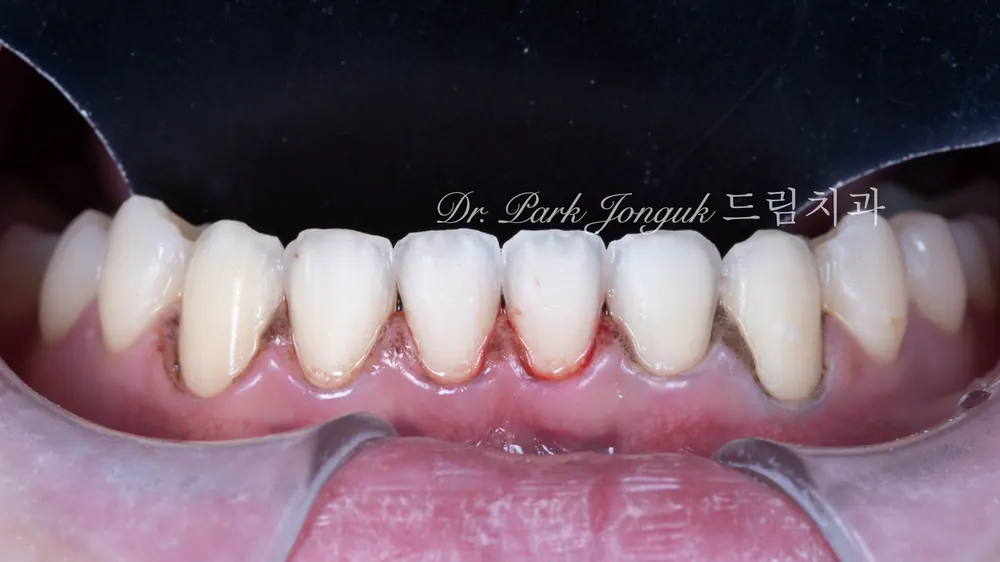 No-Prep Veneers: How to Minimize Tooth Reduction — photo 11