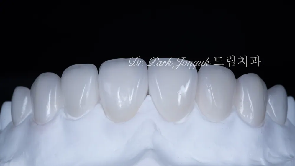 No-Prep Veneers: How to Minimize Tooth Reduction — photo 12