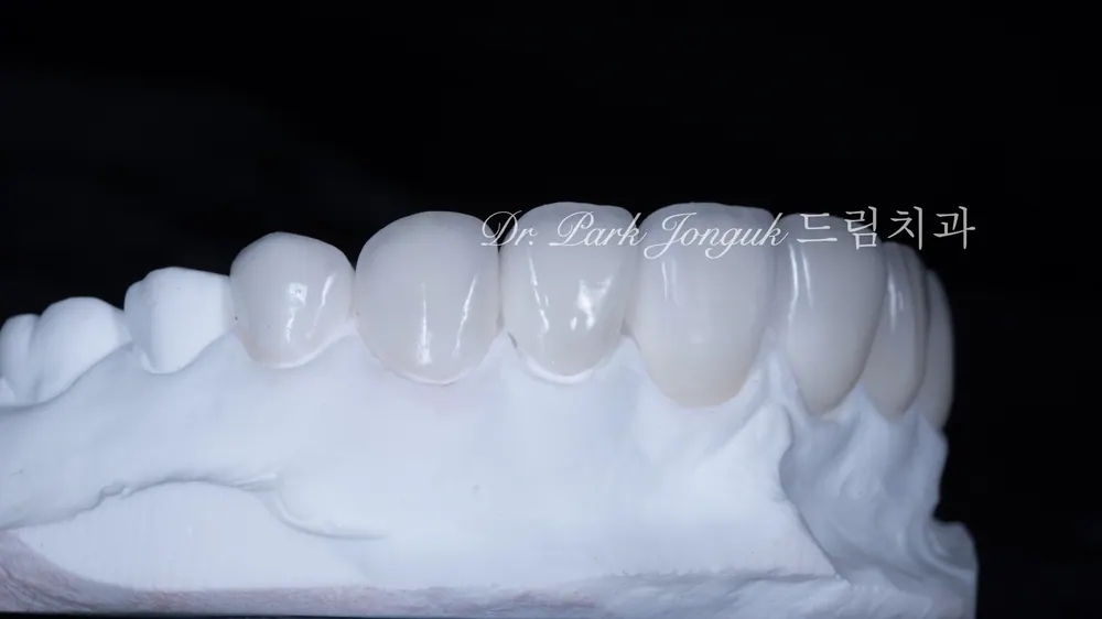 No-Prep Veneers: How to Minimize Tooth Reduction — photo 13