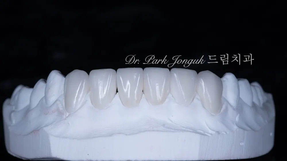 No-Prep Veneers: How to Minimize Tooth Reduction — photo 15