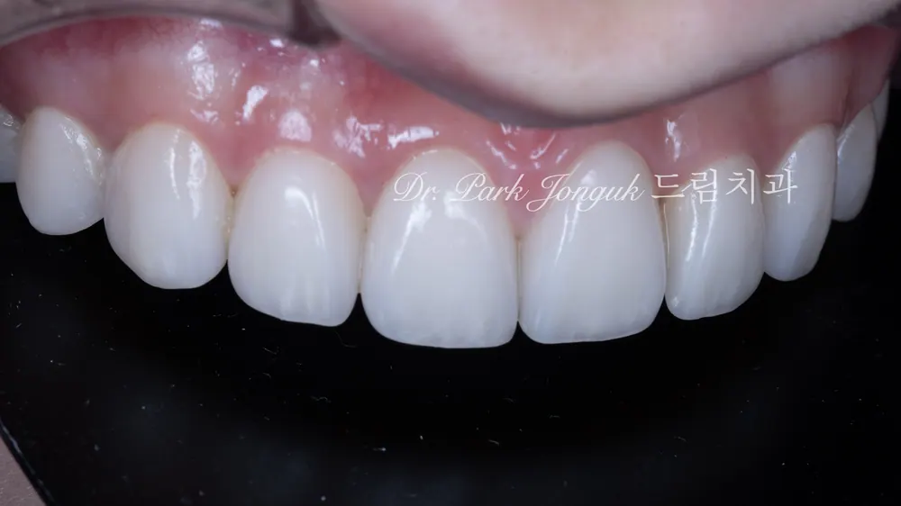 No-Prep Veneers: How to Minimize Tooth Reduction — photo 17