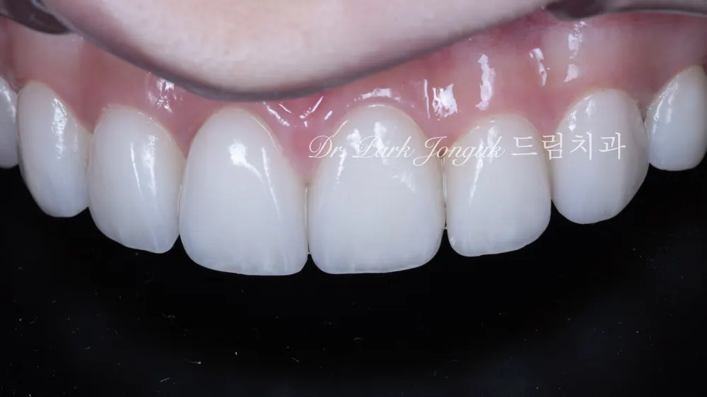 No-Prep Veneers: How to Minimize Tooth Reduction — photo 18
