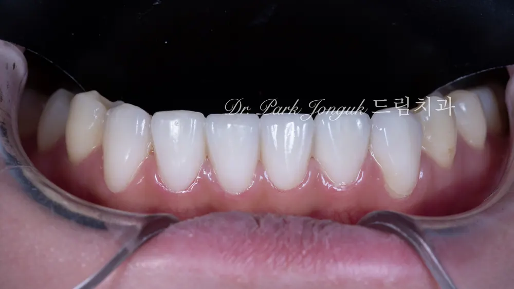No-Prep Veneers: How to Minimize Tooth Reduction — photo 19