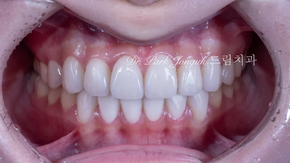 No-Prep Veneers: How to Minimize Tooth Reduction — photo 20