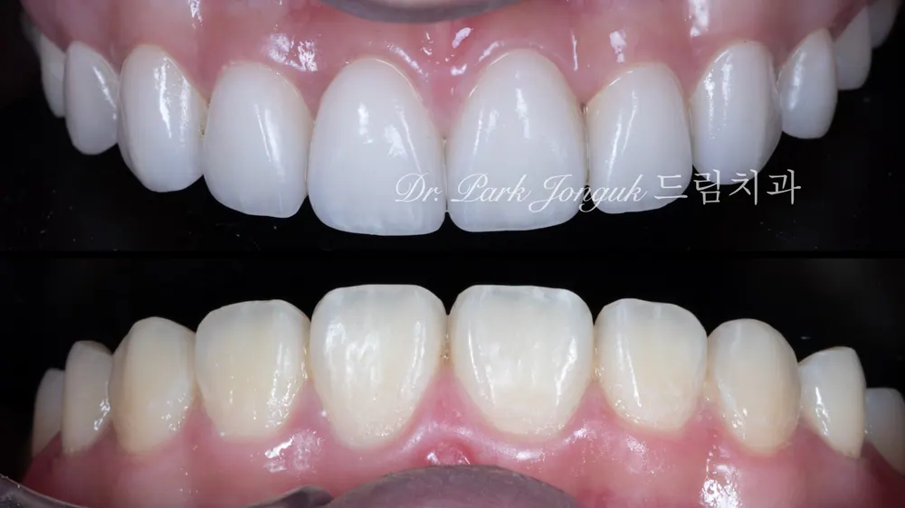 No-Prep Veneers: How to Minimize Tooth Reduction — photo 21