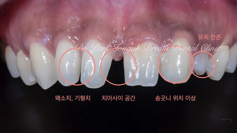 기형치, 왜소치 등 앞니 라미네이트와 브릿지, 올세라믹 크라운 치료 본문 사진 2