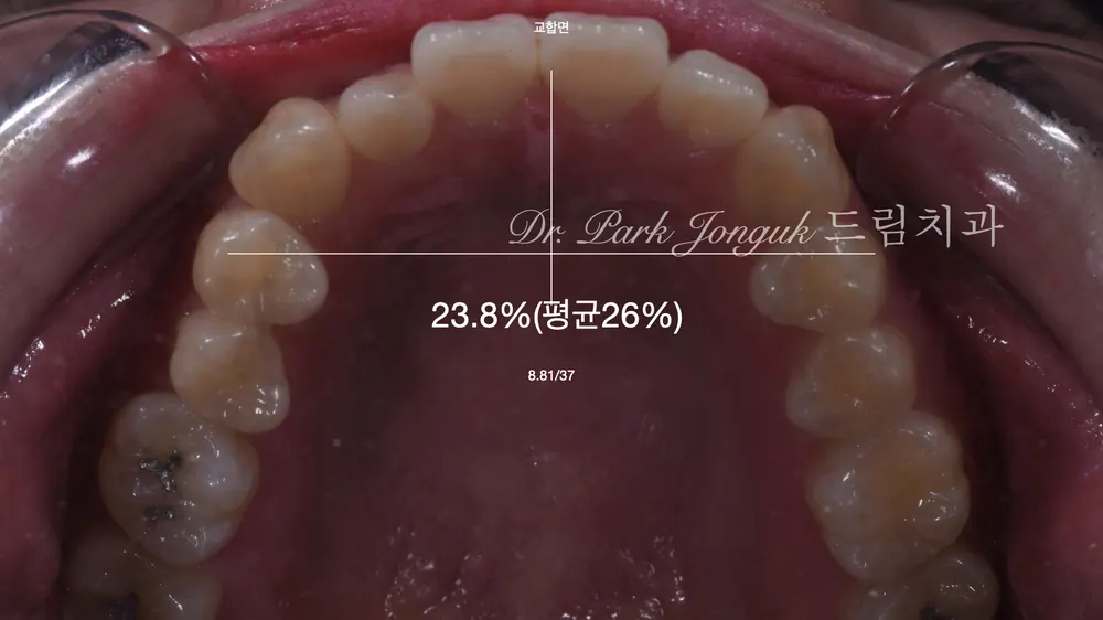 呈兔牙状外突牙齿的瓷贴面治疗 — 图5