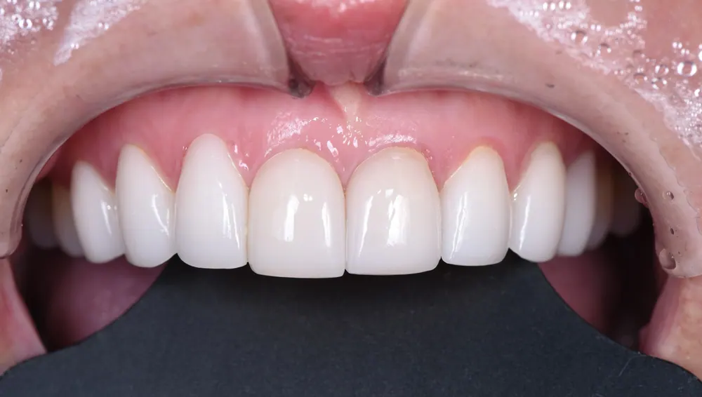 Quy trình chế tác Veneer thủ công tự nhiên — ảnh 3