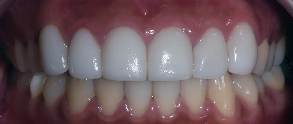 Quy trình chế tác Veneer thủ công tự nhiên — ảnh 4