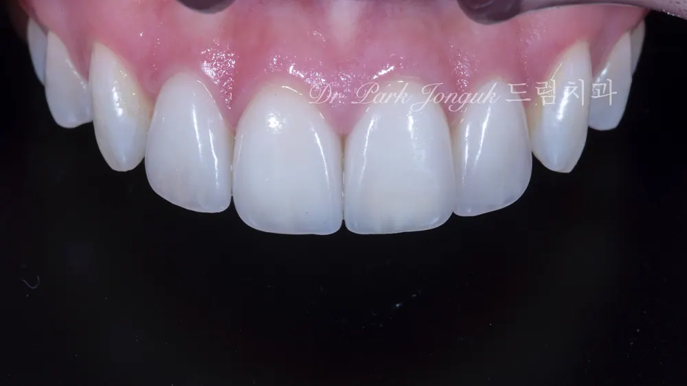 Quy trình chế tác Veneer thủ công tự nhiên — ảnh 35