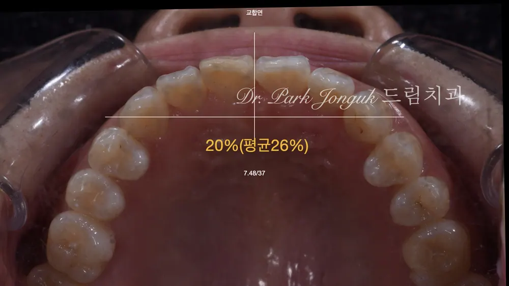 블랙 트라이앵글을 라미네이트로 치료하기 본문 사진 5
