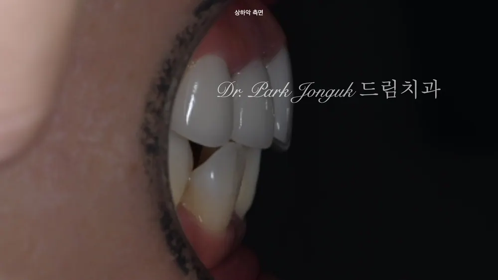 Retreating Problematic Veneers and All-Ceramic Crowns — photo 4