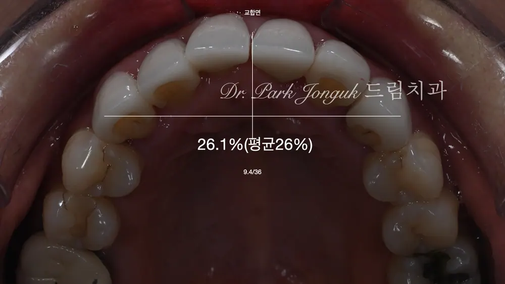 Retreating Problematic Veneers and All-Ceramic Crowns — photo 5